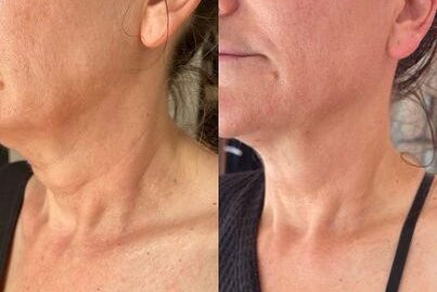 Holy Sculpt™ Bee Venom Neck Lift Sculptor