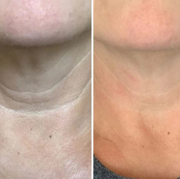 Holy Sculpt™ Bee Venom Neck Lift Sculptor